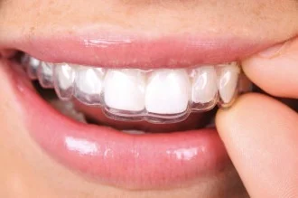 Best Teeth Clear Aligners