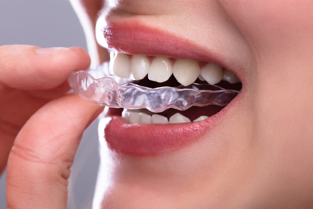 Invisible Aligners in Lahore