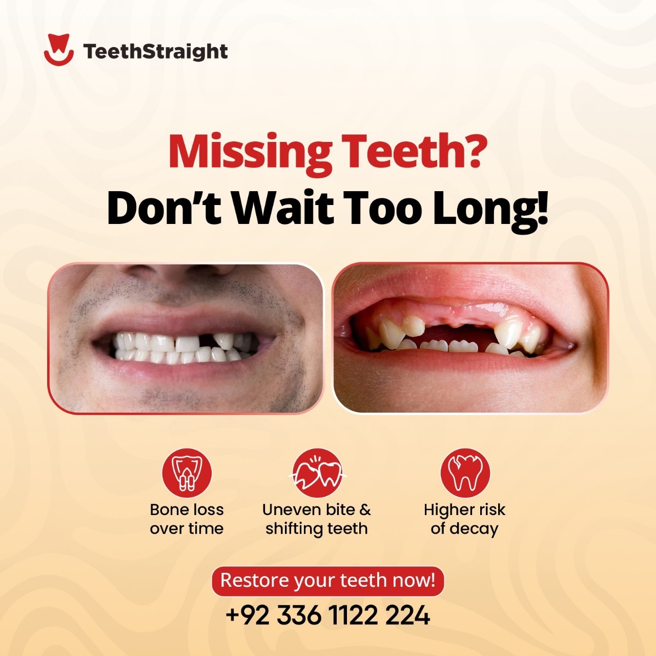 Missing Teeth don't wait too long