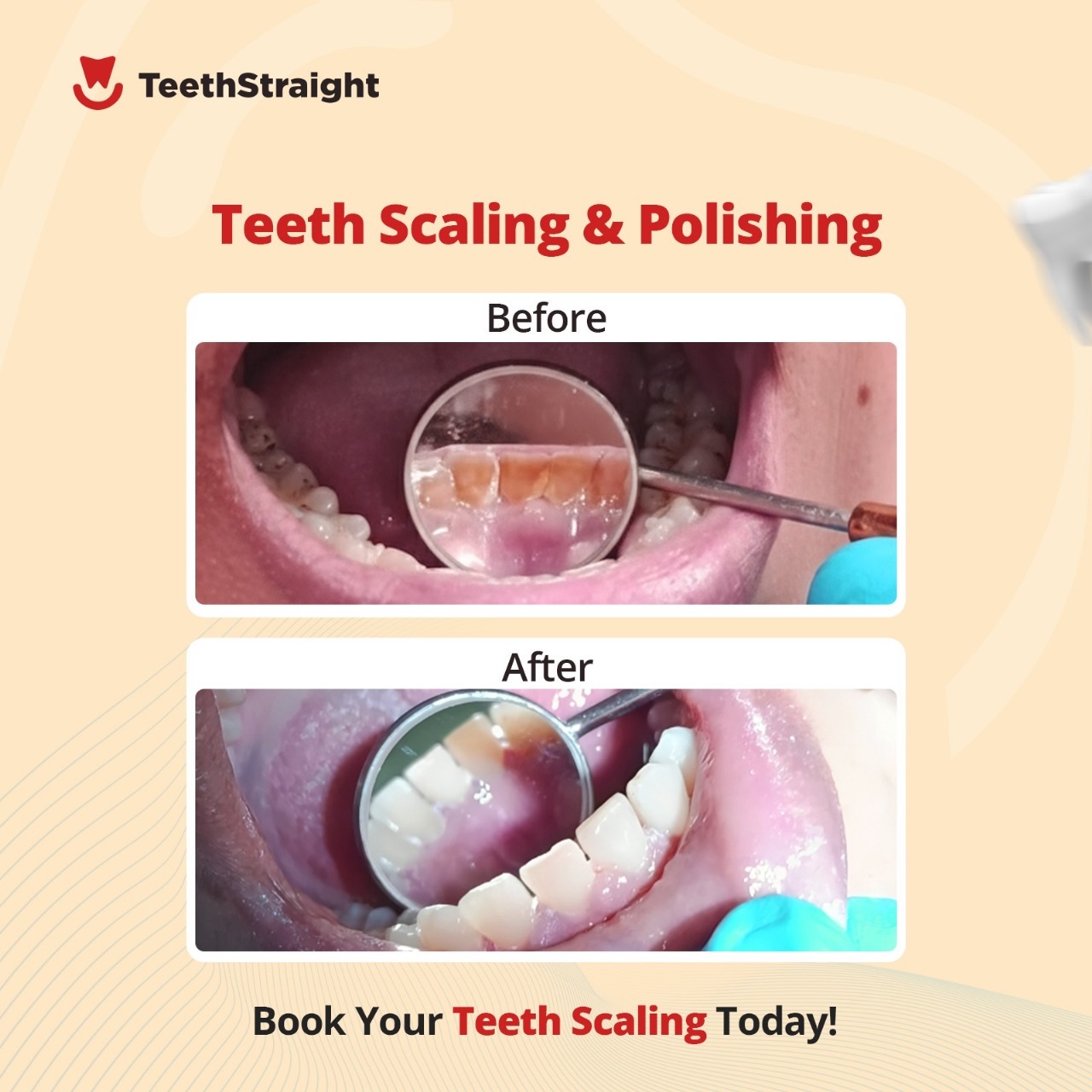 Teeth Scaling or Polishing