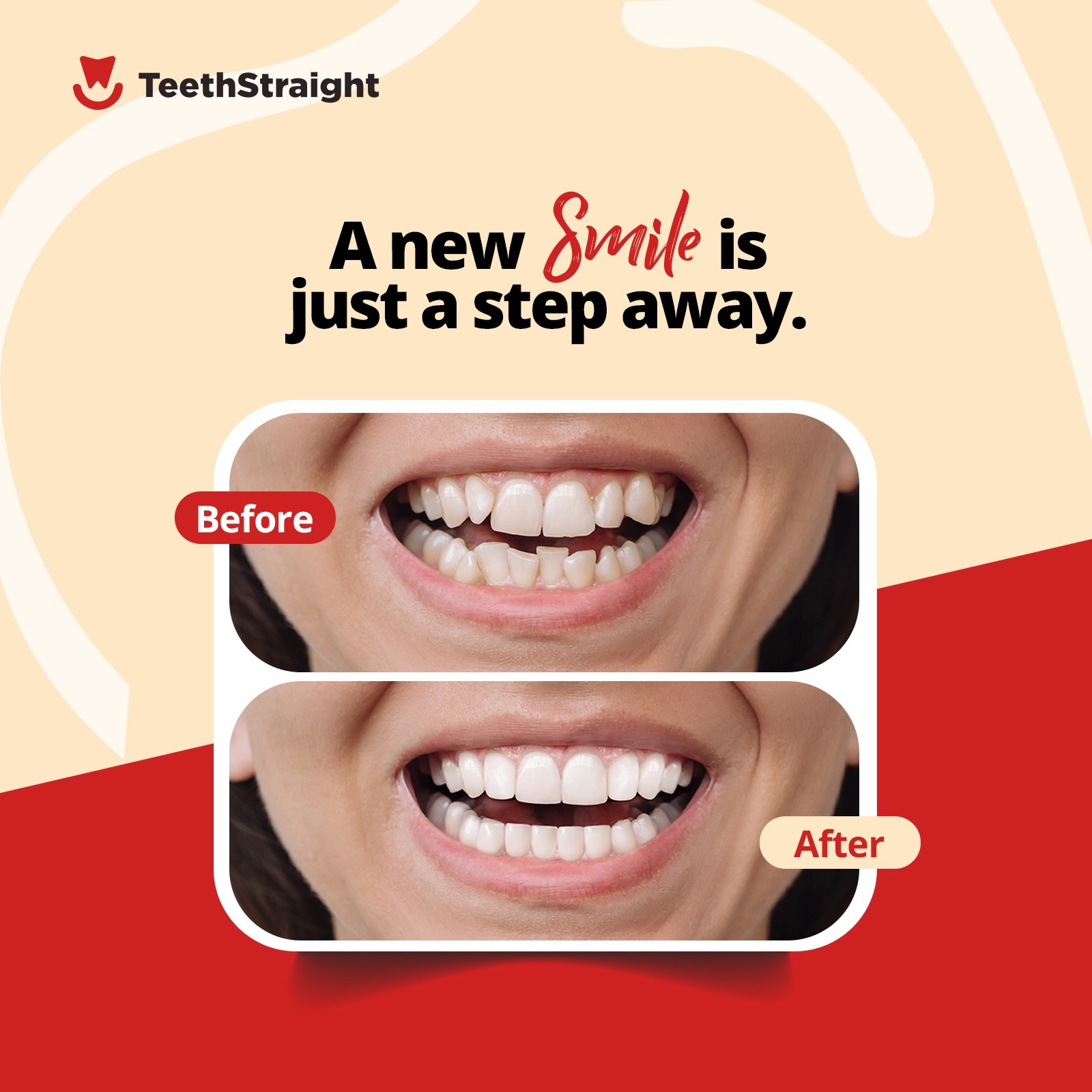 New Smile with Clear Aligners