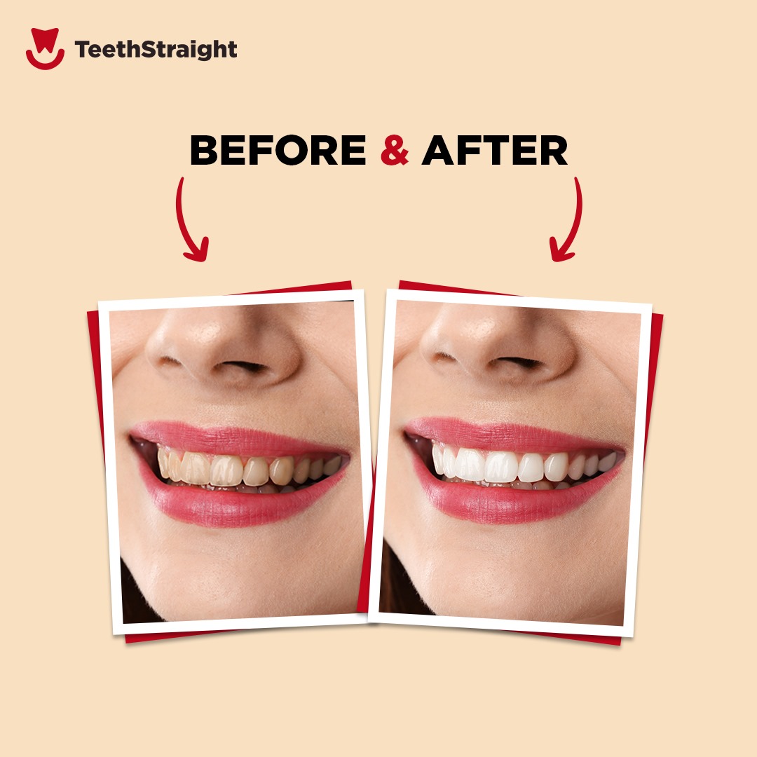 Teeth Scaling Service Before and After